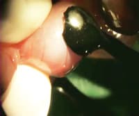 Murine In Utero Electroporation