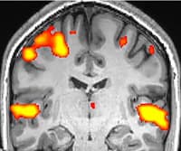 fMRI: Functional Magnetic Resonance Imaging