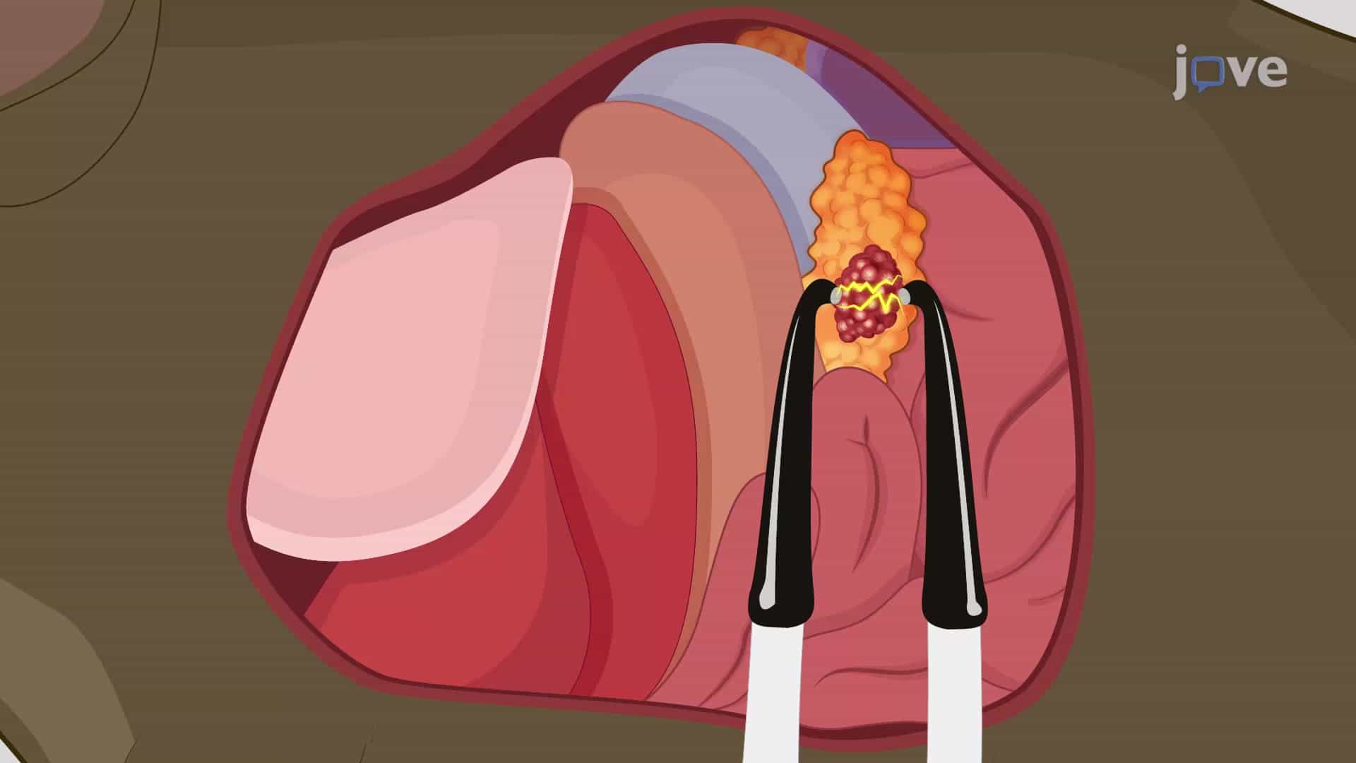 Irreversible Electroporation: A Technique for Ablating Pancreatic Tumor in Mouse