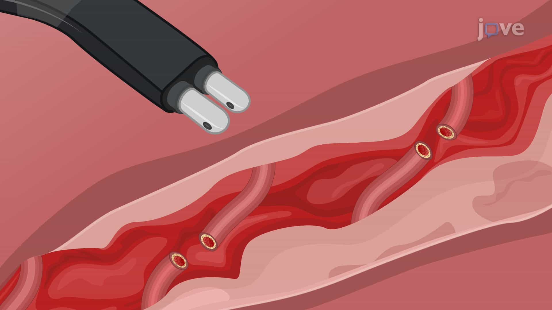 Bipolar Radiofrequency-Based Hemorrhage Arrest in Solid Organ Injury: A Technique to Arrest Bleeding in Porcine Model With Liver Injury Using Electrosurgery