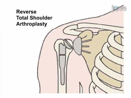 Reverse Total Shoulder Arthroplasty