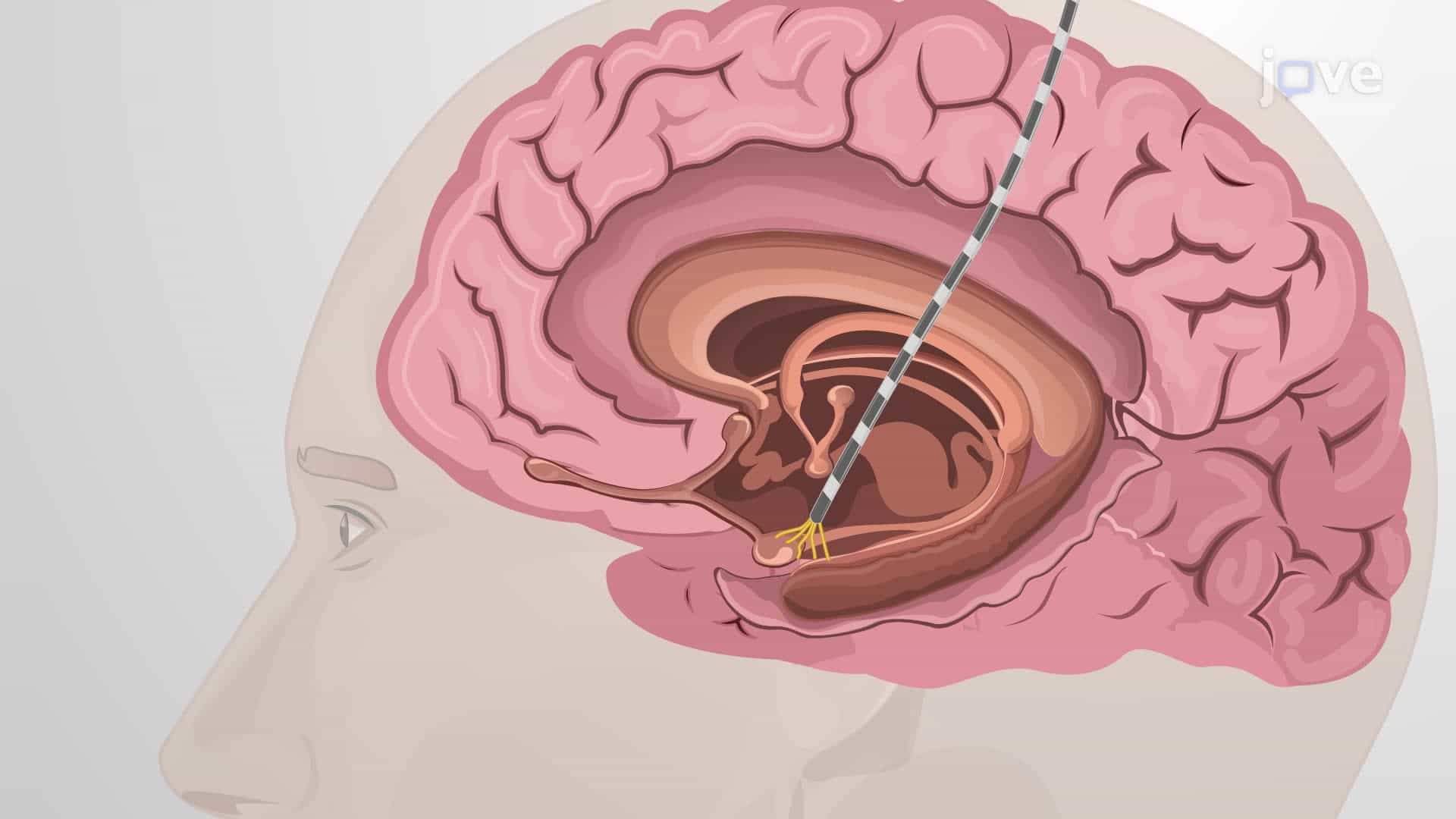 Simultaneous Eye Tracking and Single-Neuron Recording to Identify Target-Selective Neurons