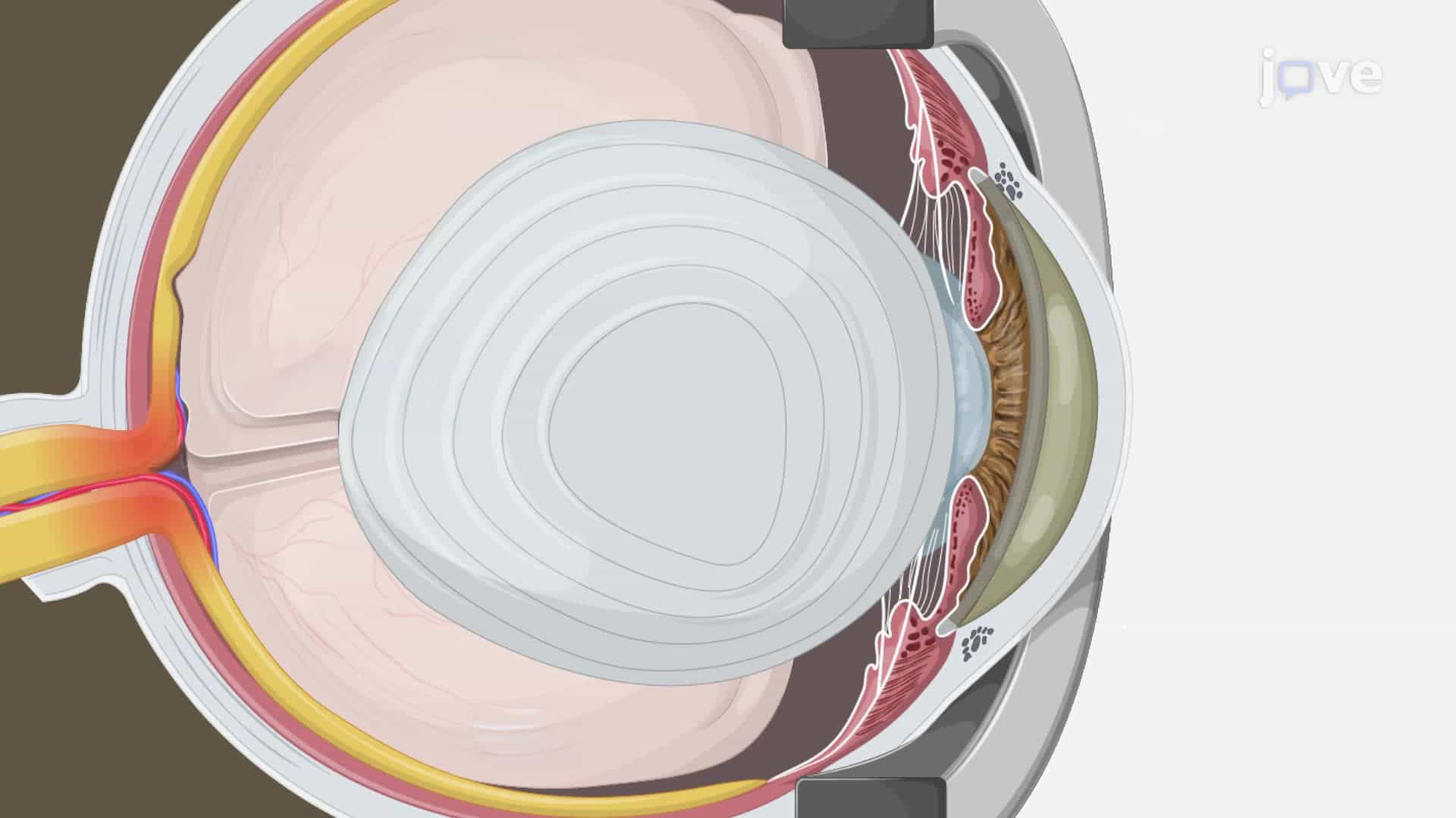 Experimental Glaucoma Induction via Iridocorneal Angle Obstruction In a Mouse Model