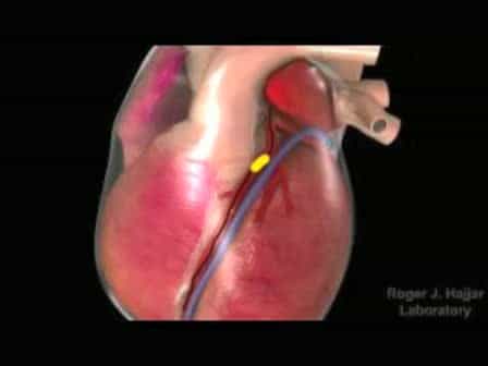 Gene Transfer for Ischemic Heart Failure in a Preclinical Model