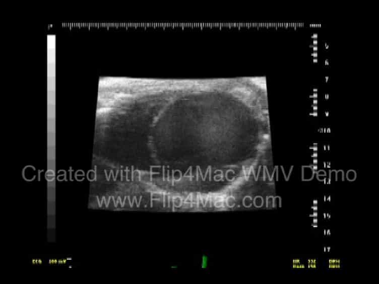 The Application Of Permanent Middle Cerebral Artery Ligation in the Mouse