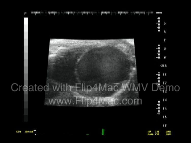 The Application Of Permanent Middle Cerebral Artery Ligation in the Mouse