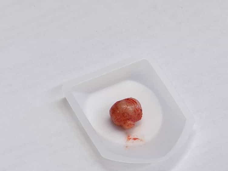 An Orthotopic Murine Model of Human Prostate Cancer Metastasis
