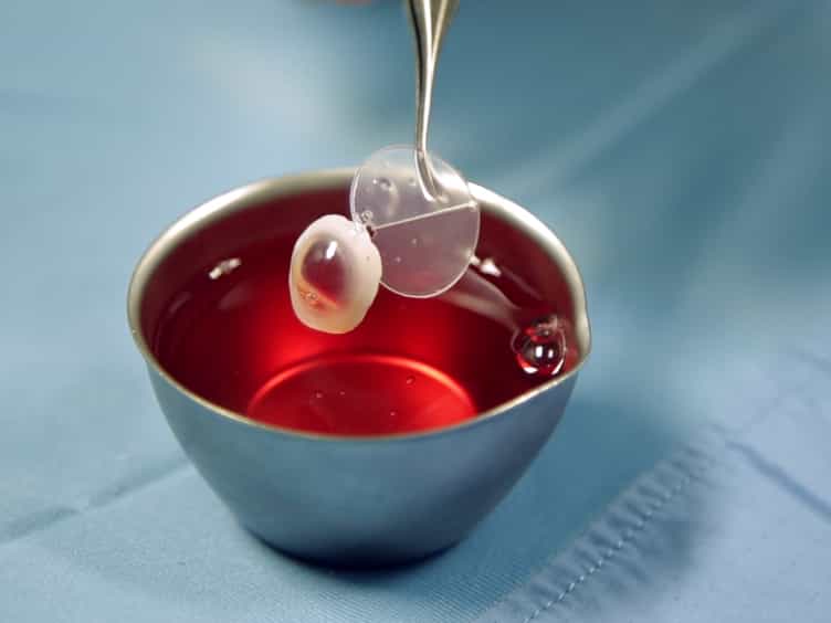 An “All-laser” Endothelial Transplant