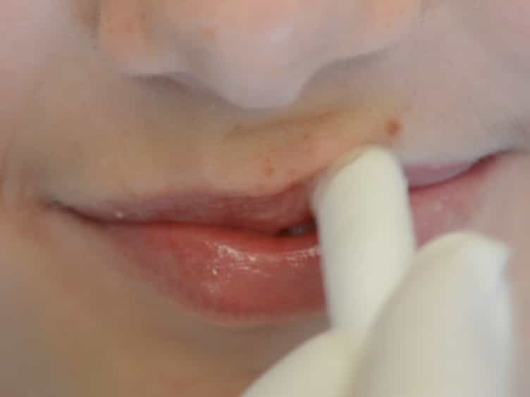 Oral Biofilm Sampling for Microbiome Analysis in Healthy Children