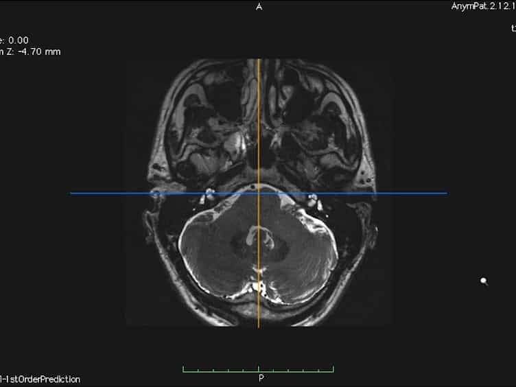 In Vivo Morphometric Analysis of Human Cranial Nerves Using Magnetic Resonance Imaging in Menière's Disease Ears and Normal Hearing Ears