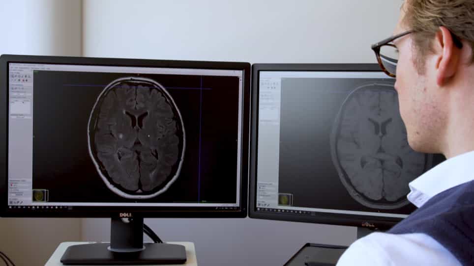 Brain Infarct Segmentation and Registration on MRI or CT for Lesion-symptom Mapping