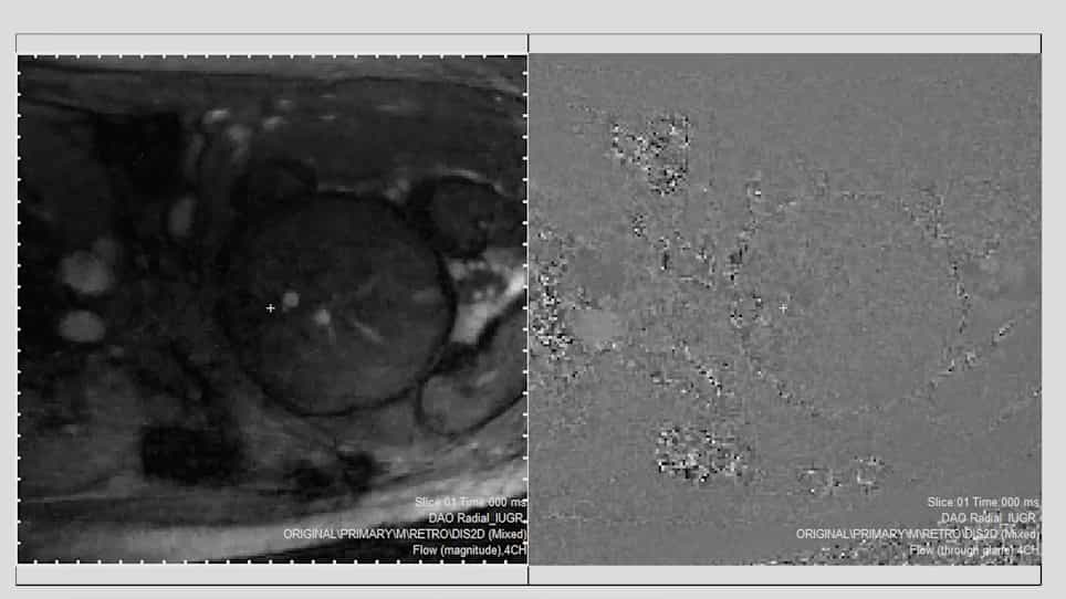 Human Fetal Blood Flow Quantification with Magnetic Resonance Imaging and Motion Compensation