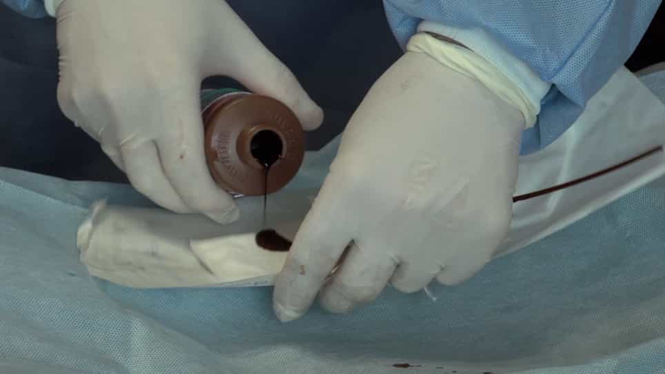 Application of Lucilia sericata Larvae in Debridement of Pressure Wounds in Outpatient Settings