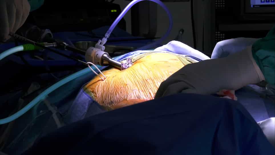 Neuronavigation and Laparoscopy Guided Ventriculoperitoneal Shunt Insertion for the Treatment of Hydrocephalus