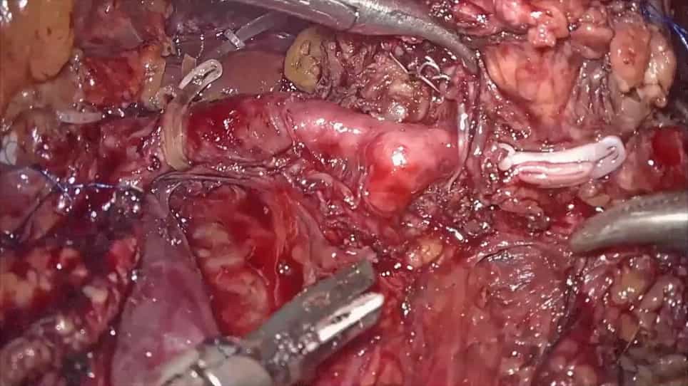 Laparoscopic Radical Antegrade Modular Pancreatosplenectomy via Dorsal-Caudal Artery Approach for Pancreatic Neck-Body Cancer