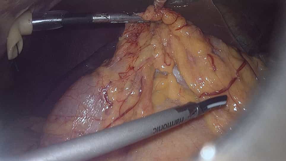 Laparoscopic Pancreatoduodenectomy for Pancreatic Cancer Using In-Situ No-Touch Isolation Technique