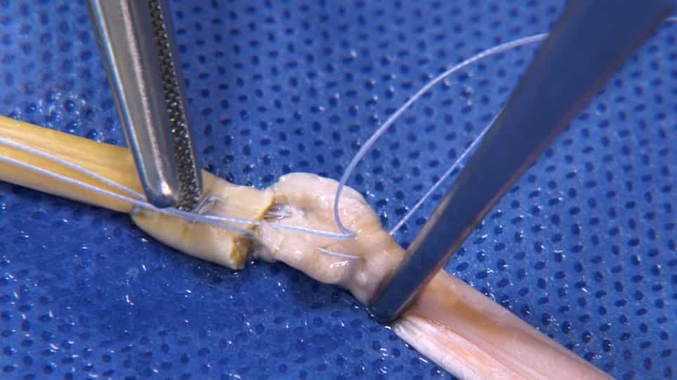 Polytetrafluoroethylene PTFE as a Suture Material in Tendon Surgery