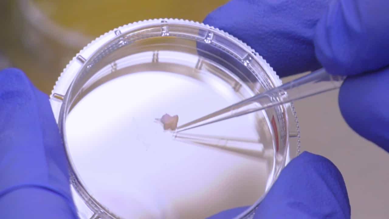 Author Spotlight: Generation of Patient-Derived Podocytes from Skin Biopsies