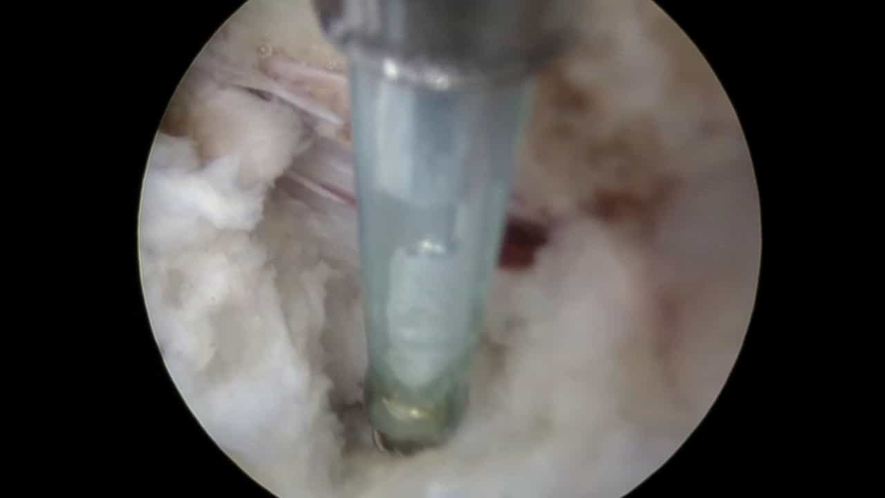 Full-Endoscopic Transforaminal Approach for Lumbar Discectomy