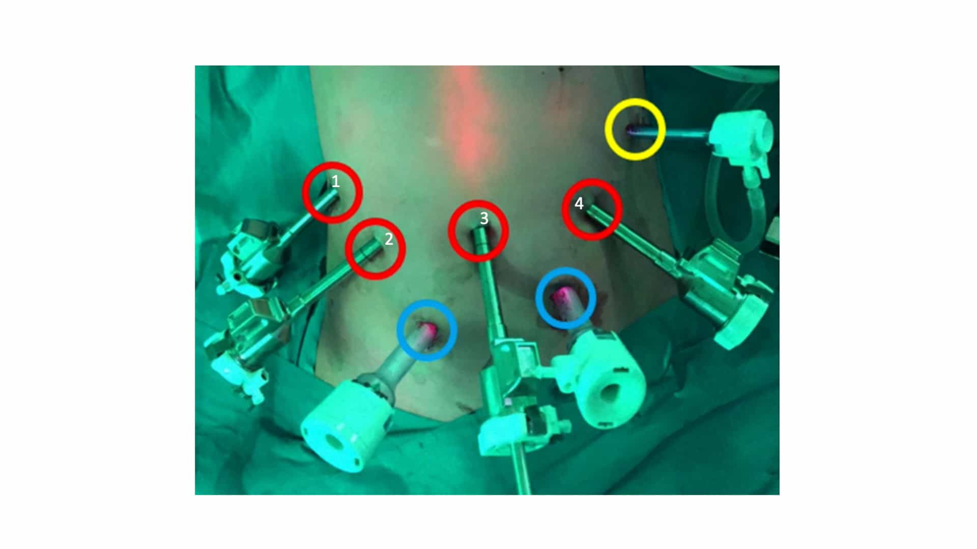 Robotic D3 Partial Duodenal Resection with Primary Side-to-Side Anastomosis