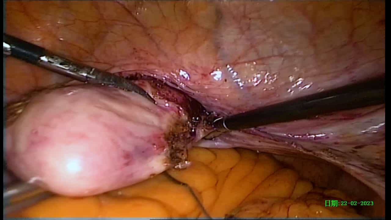 Author Spotlight: Advancing Pelvic Prolapse Treatment with a Non-Mesh Approach using Laparoscopic Pectopexy