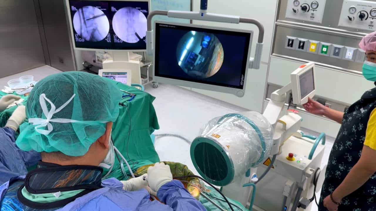 Uniportal Full Endoscopic Posterolateral Transforaminal Lumbar Interbody Fusion