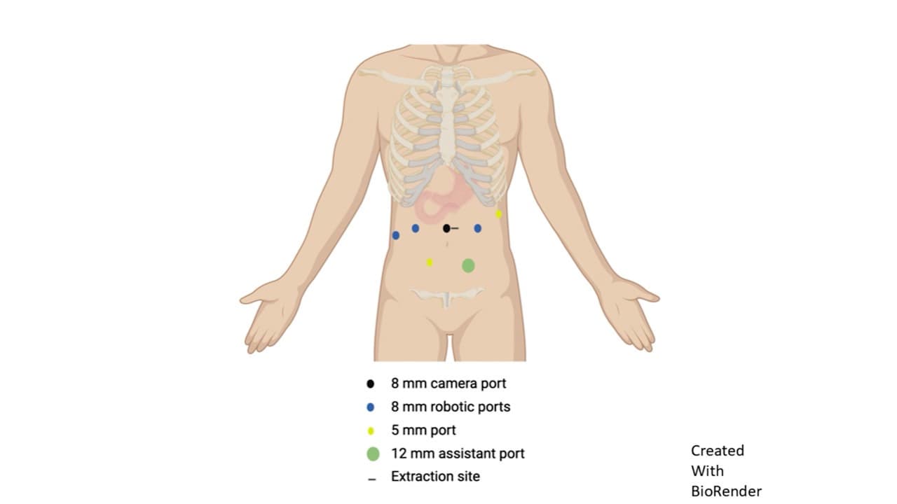 Robotic Duodenal Sleeve Resection for Gastrointestinal Stromal Tumor with Rare Exon 8 KIT Mutation Following Neoadjuvant Imatinib