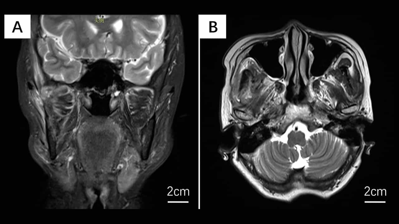 Lateral Molar Approach-Driven Transoral Endoscopic Procedure for Benign Infratemporal Fossa Tumor Resection