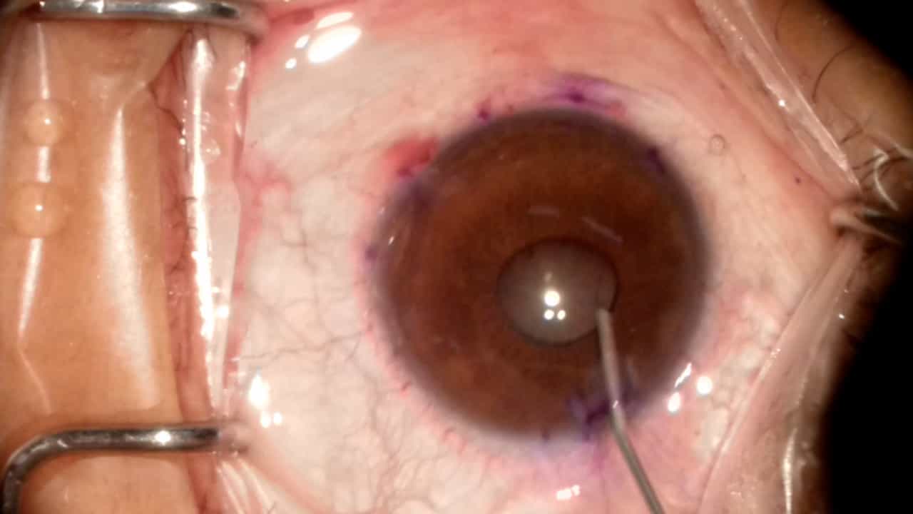 Trabeculotome Tunneling Trabeculoplasty (3T): A Step-by-Step Surgical Protocol for Primary Open-angle Glaucoma