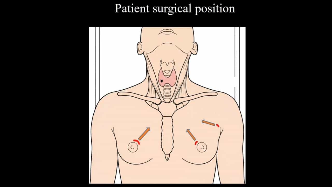 A Novel Contralateral Axillo-Bilateral-Breast Approach for Endoscopic Thyroid Surgery