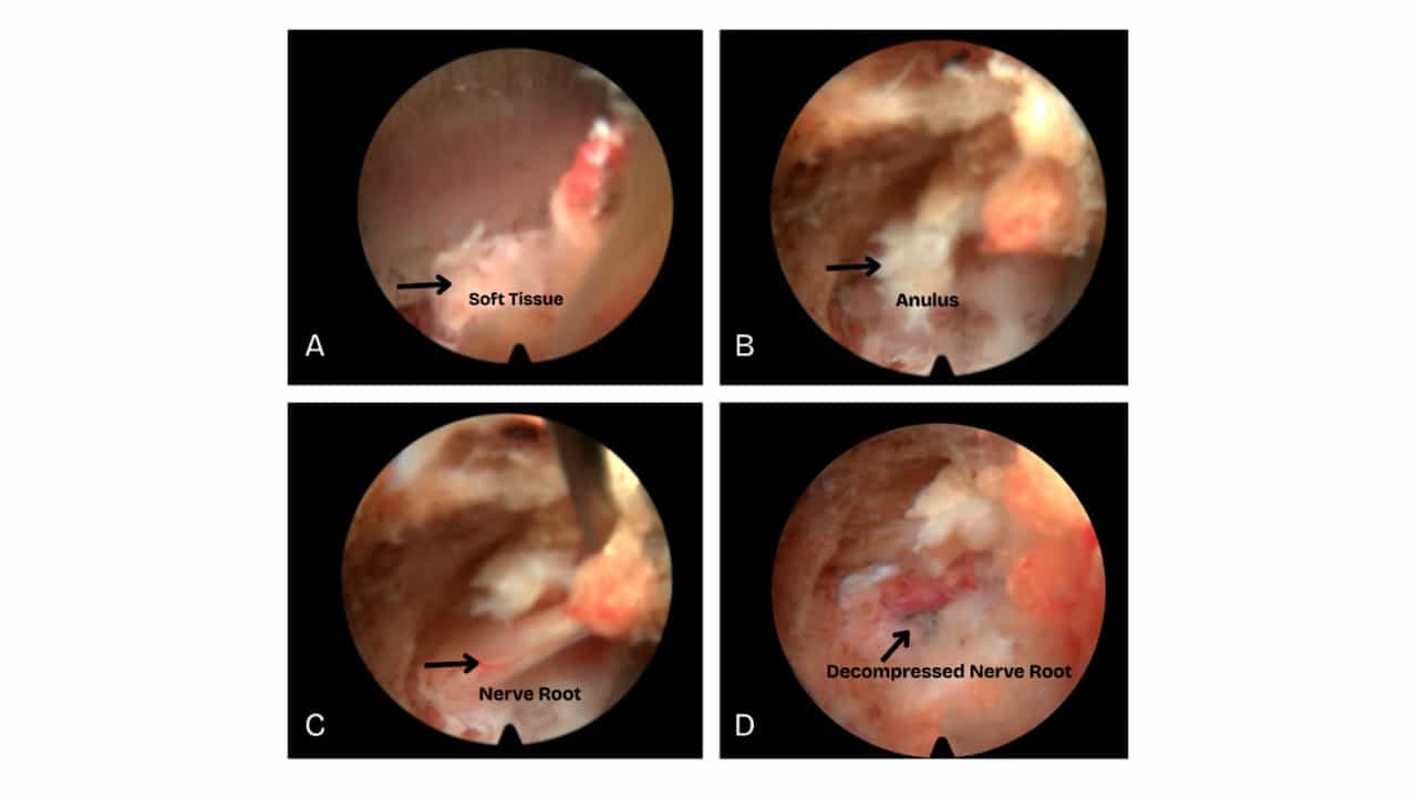 Uniportal Endoscopic Techniques for Lumbar Decompression: Interlaminar Microdiscectomy, Interlaminar Laminectomy, and Transforaminal Microdiscectomy