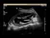 Laparoscopic Pyeloplasty via Transmesenteric Approach for Pediatric Ureteropelvic Junction Obstruction
